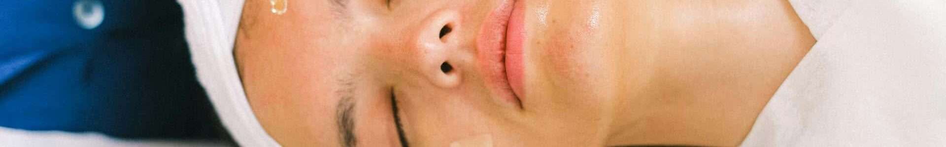 Lactic Acid Chemical Peel